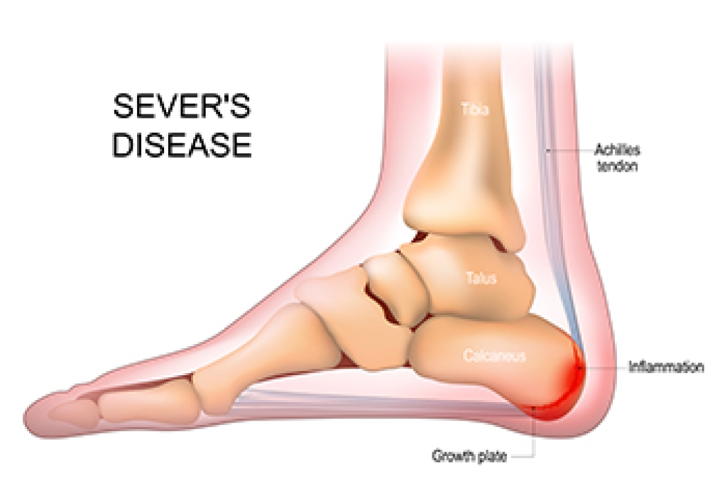 Sever’s Disease and Heel Pain in Growing Children