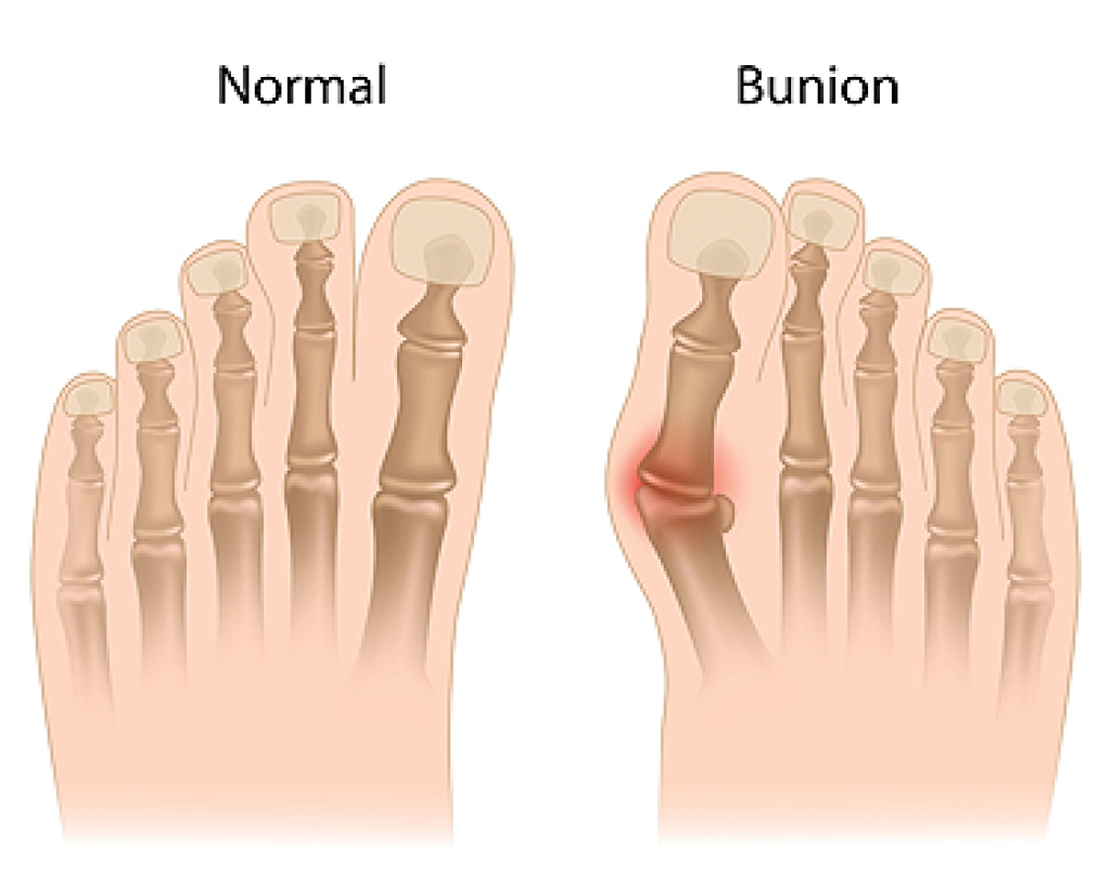 Painful Bunions and How a Podiatrist Can Help