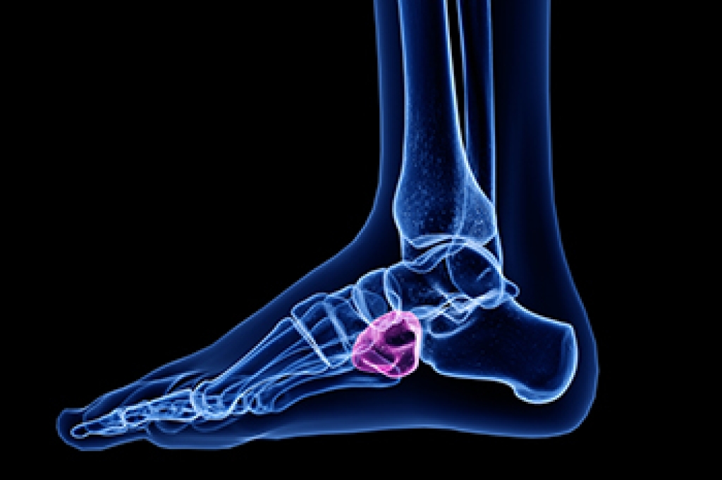 Cuboid Syndrome in Athletes and Active Individuals