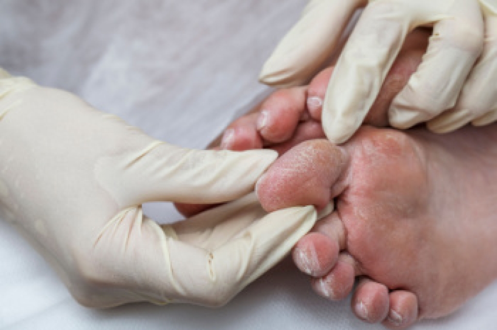 Symptoms of Diabetic Foot Problems