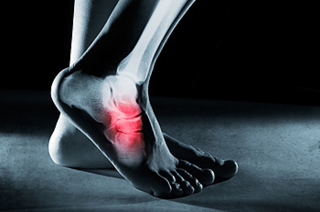 Foot Stress Fractures From Repetitive Impact
