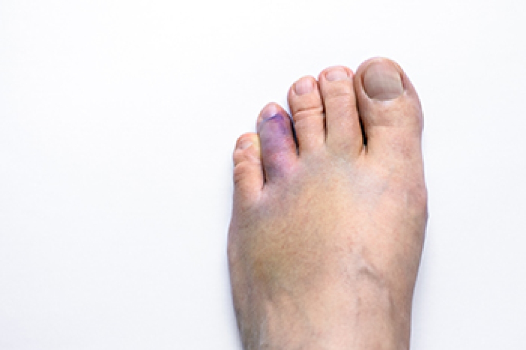 Broken Toe Symptoms Podiatric Care