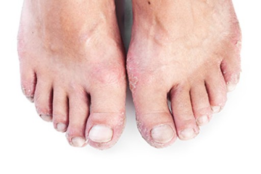 Systemic Diseases of the Foot