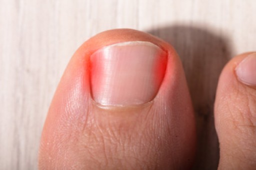 Causes and Signs of Ingrown Toenails