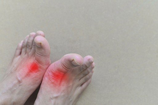 Everything You Need to Know About Gout
