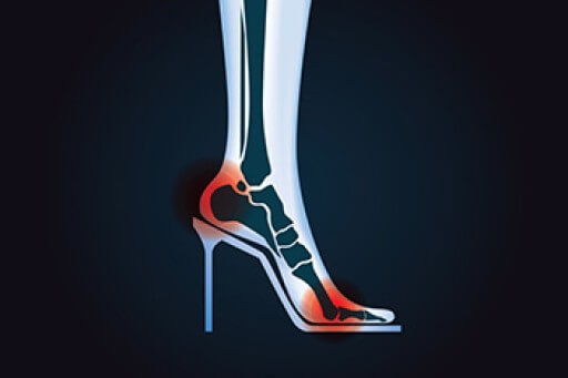 How High Heels Can Affect the Feet