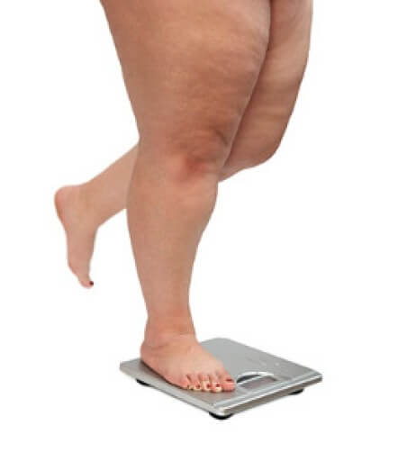 How Obesity Affects Your Feet