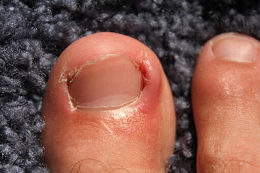 Causes and Symptoms of Ingrown Toenails