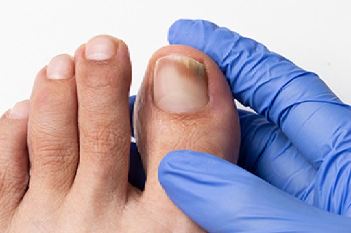 How to Treat Your Toenail Fungus