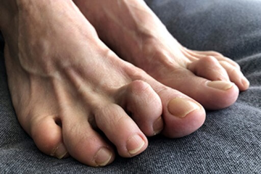 Causes and Solutions for Hammertoe