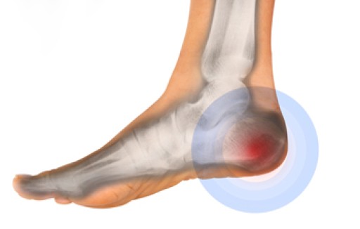 Causes of Morning Heel Pain