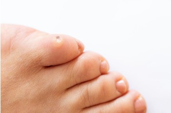 Risk Factors for Developing Foot Corns