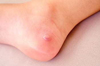 What You Need to Know About Diabetic Blisters on the Feet