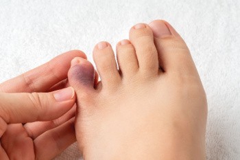 Broken Toes and How Early Care Supports Recovery