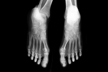 Understanding Lisfranc Injuries