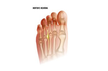 Morton’s Neuroma Symptoms