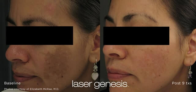 laser result 2