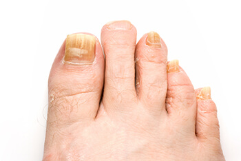 Fungal Toenails Treatment | Foot Doctor Boston, MA 02116